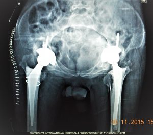 FINAL-POST-OP-X-RAY