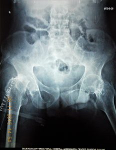FIRST-OPERATION-X-RAY-AFTER-BL-FEMUR-NECK-OSTEOTOMY