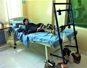 SKELETAL-TRACTION-FOR-HIP-AND-KNEE-CONTRACTURE-RELEASE